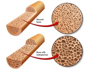Osteoporosis bone density testing
