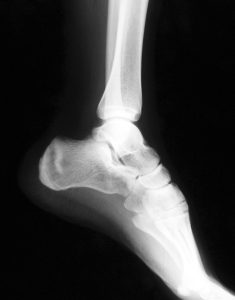 Treating Broken Bones - Fracture